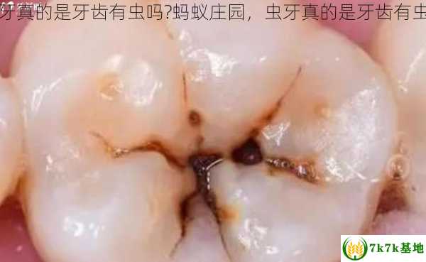 虫牙真的是牙齿有虫吗?蚂蚁庄园，虫牙真的是牙齿有虫吗